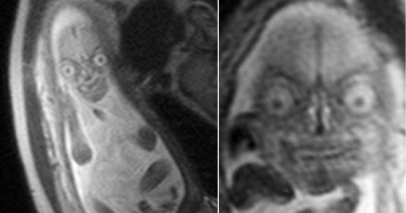 Disturbing MRI Images of Unborn Baby Leave Onlookers Horrified